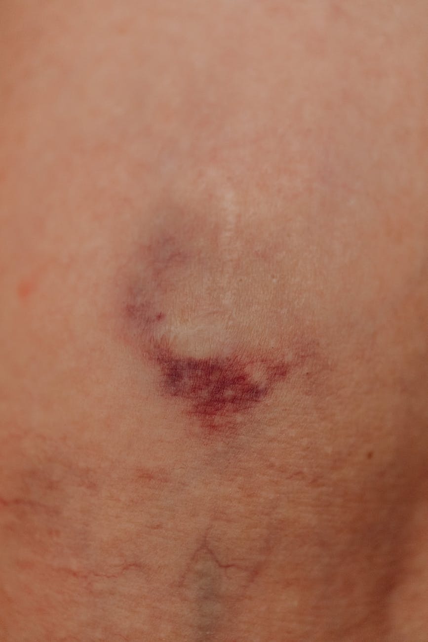 close up of a bruise